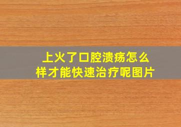 上火了口腔溃疡怎么样才能快速治疗呢图片