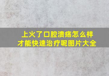 上火了口腔溃疡怎么样才能快速治疗呢图片大全