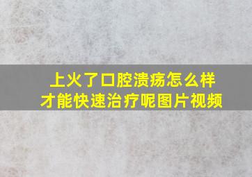 上火了口腔溃疡怎么样才能快速治疗呢图片视频