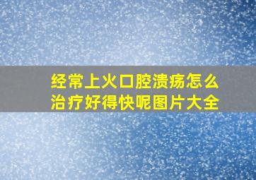 经常上火口腔溃疡怎么治疗好得快呢图片大全