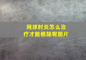 网球肘炎怎么治疗才能根除呢图片