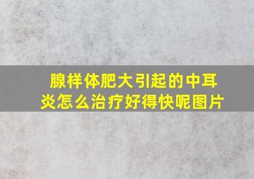 腺样体肥大引起的中耳炎怎么治疗好得快呢图片