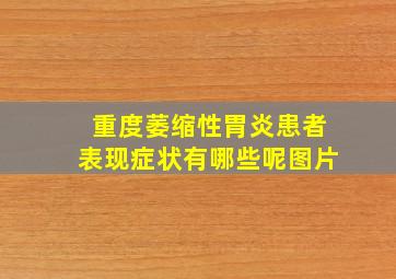 重度萎缩性胃炎患者表现症状有哪些呢图片