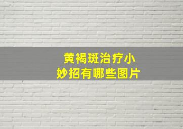 黄褐斑治疗小妙招有哪些图片