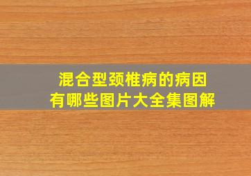 混合型颈椎病的病因有哪些图片大全集图解