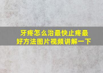 牙疼怎么治最快止疼最好方法图片视频讲解一下