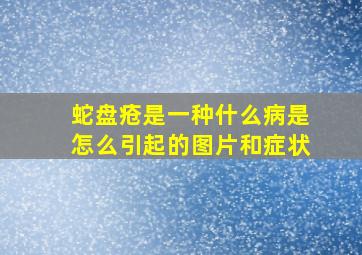 蛇盘疮是一种什么病是怎么引起的图片和症状